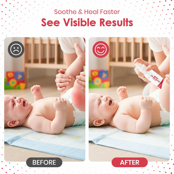 Seudo Spray ® 50 ML – Gentle Baby Skin Soothing Mist.